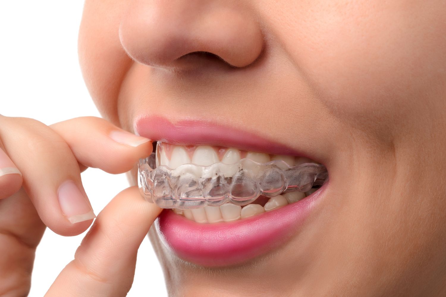 Invisalign aligner