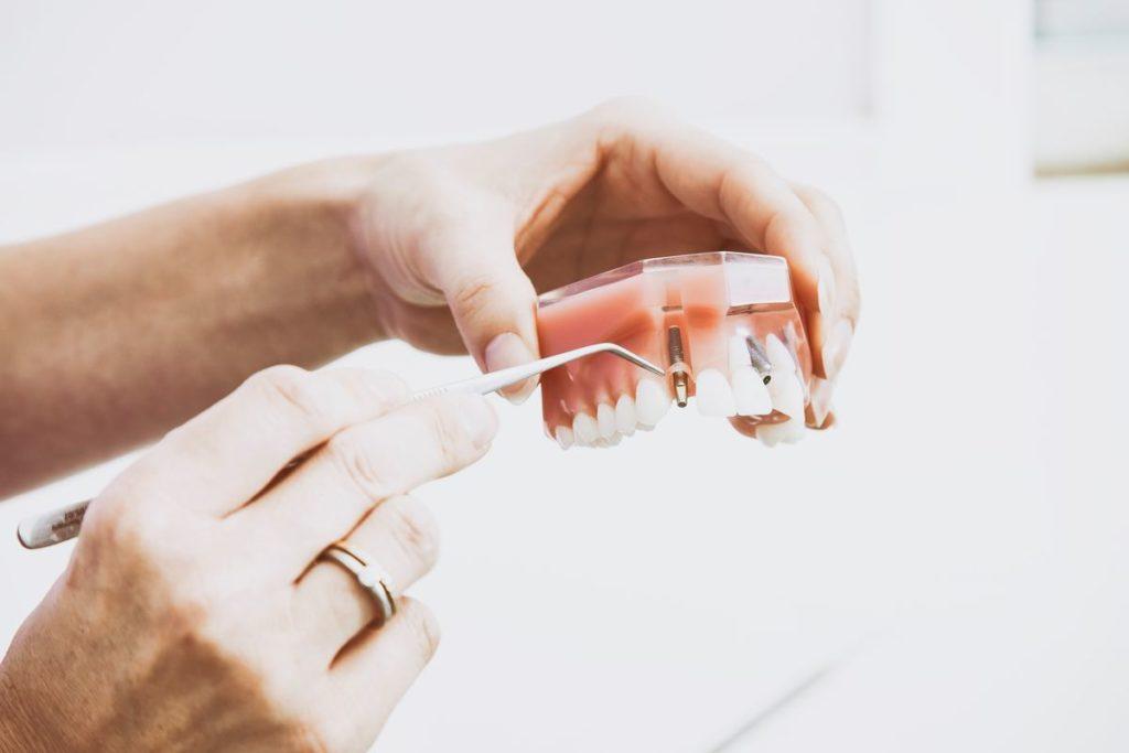 Replacing Missing Teeth with Braces