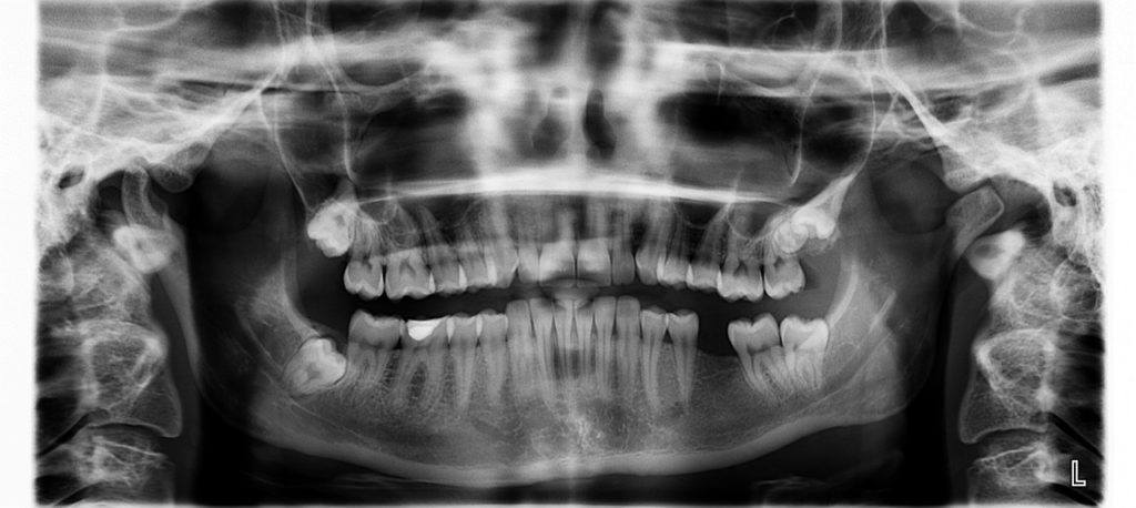 it's possible to get braces with missing teeth